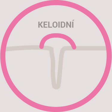keloidní